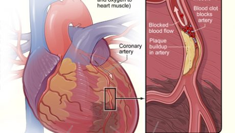 Ce este infarctul miocardic?