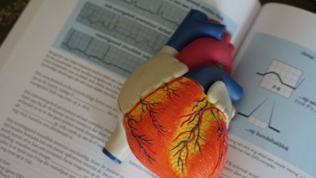Cardiomiopatia dilatativa