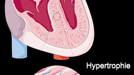 Cardiomiopatia hipertrofica